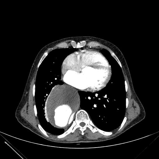 Aortic dissection (Radiopaedia 27466-27665 C+ arterial phase 180).jpg