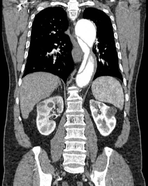 Aortic dissection (Radiopaedia 44411-48061 A 41).jpg