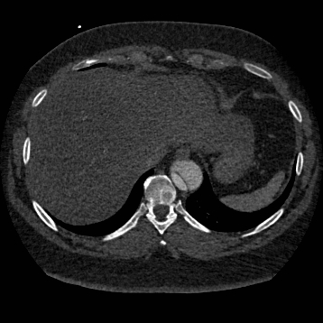 File:Aortic dissection (Radiopaedia 57969-64959 A 256).jpg