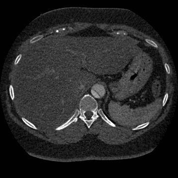 Aortic dissection (Radiopaedia 57969-64959 A 292).jpg