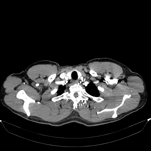 Aortic dissection - Stanford type A (Radiopaedia 83418-98500 A 6).jpg