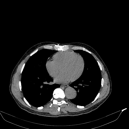 File:Aortic dissection - Stanford type A (Radiopaedia 83418-98500 Axial non-contrast 28).jpg