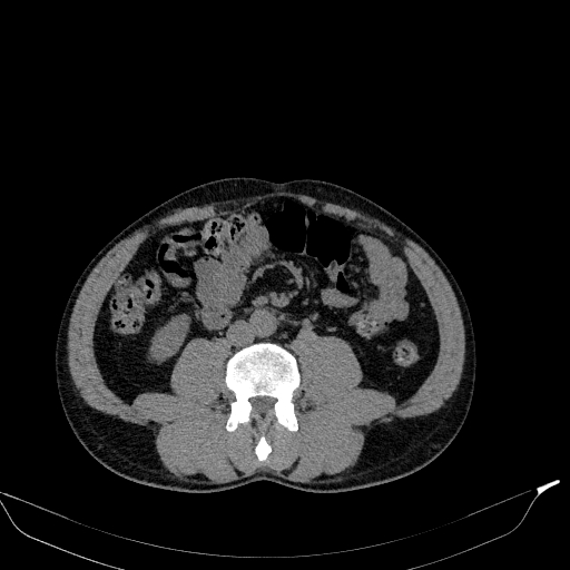 File:Aortic dissection - Stanford type A (Radiopaedia 83418-98500 Axial non-contrast 62).jpg