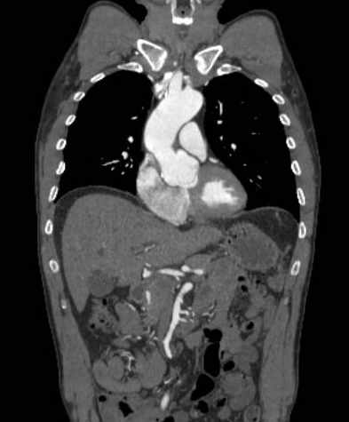 File:Aortic dissection - Stanford type B (Radiopaedia 73648-84437 B 45).jpg