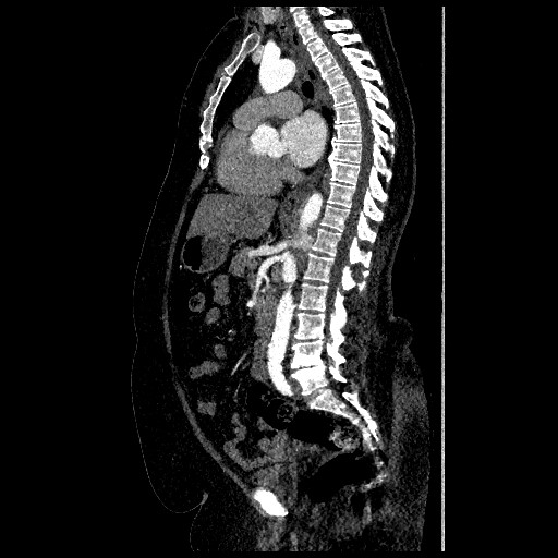 File:Aortic dissection - Stanford type B (Radiopaedia 88281-104910 C 40).jpg