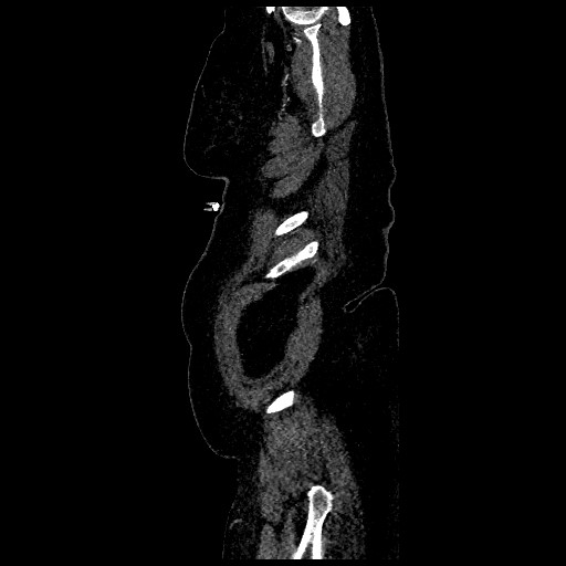 File:Aortic dissection - Stanford type B (Radiopaedia 88281-104910 C 81).jpg