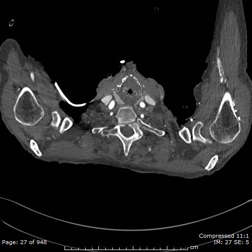 Aortic dissection with extension into aortic arch branches (Radiopaedia 64402-73204 B 27).jpg