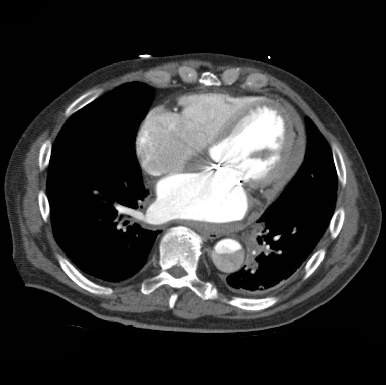 Aortic dissection with rupture into pericardium (Radiopaedia 12384-12647 A 37).jpg