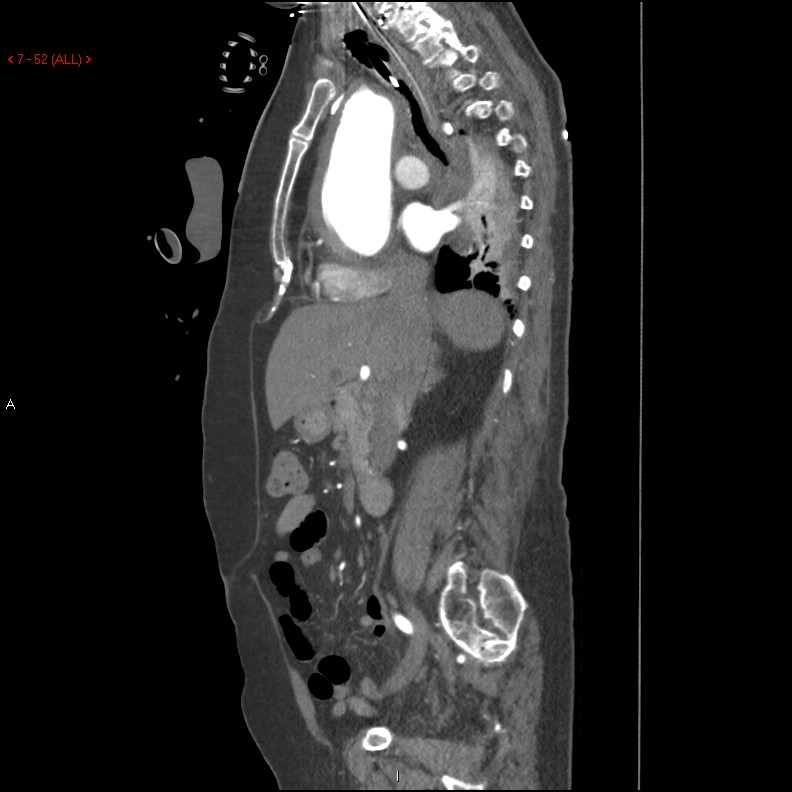 Aortic intramural hematoma (Radiopaedia 27746-28001 C 21).jpg