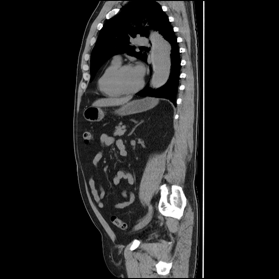 Aortic intramural hematoma (type B) (Radiopaedia 79323-92387 G 34).jpg