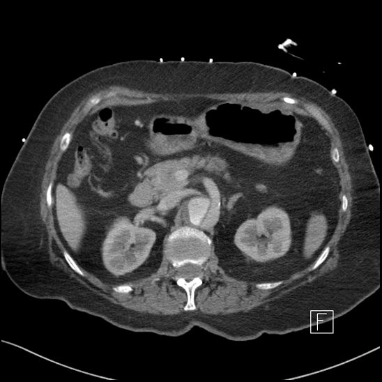 Aortic intramural hematoma with dissection and intramural blood pool (Radiopaedia 77373-89491 E 19).jpg