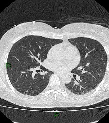 File:Aortic valve endocarditis (Radiopaedia 87209-103485 Axial lung window 54).jpg