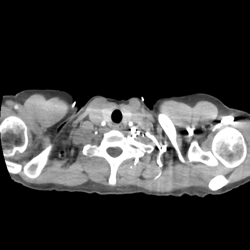 Aortic valve non-coronary cusp thrombus (Radiopaedia 55661-62189 B 2).png