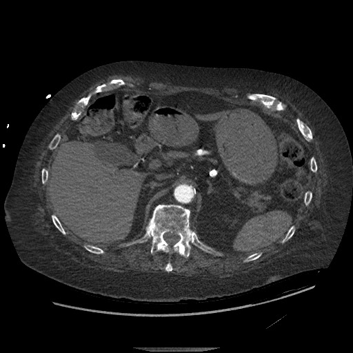 Aortoesophageal fistula with endovascular repair (Radiopaedia 73781-84592 Axial C+ CTPA 183).jpg