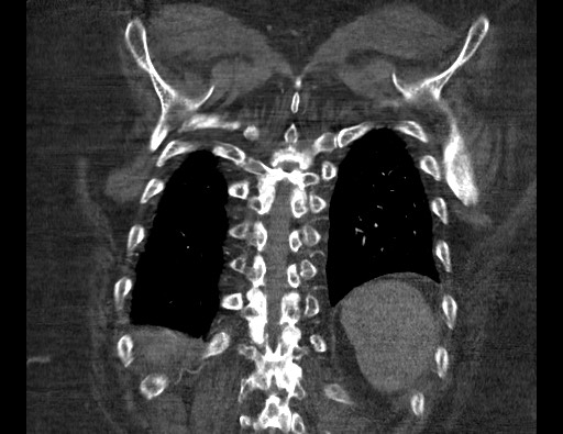 Aortoesophageal fistula with endovascular repair (Radiopaedia 73781-84592 Coronal C+ CTPA 117).jpg