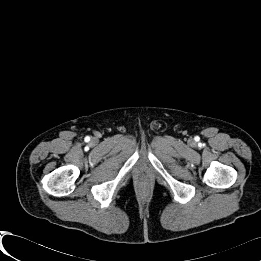 Appendiceal adenocarcinoma complicated by retroperitoneal abscess (Radiopaedia 58007-65039 B 152).jpg