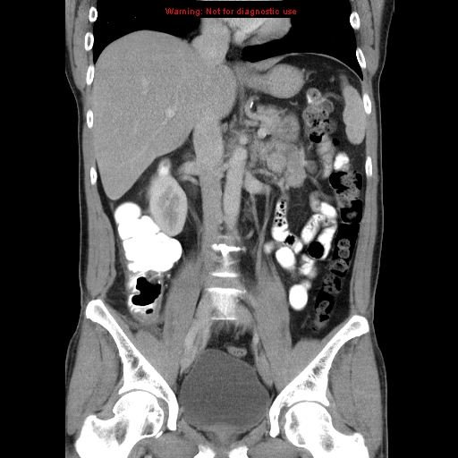 File:Appendicitis and renal cell carcinoma (Radiopaedia 17063-16760 B 16).jpg