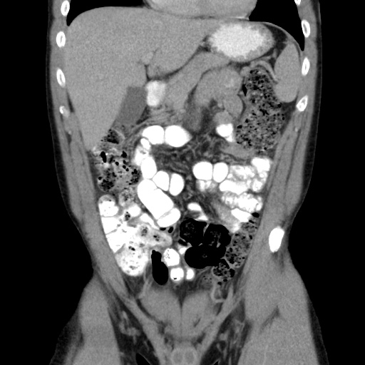 Appendicitis complicated by post-operative collection (Radiopaedia 35595-37113 B 20).jpg