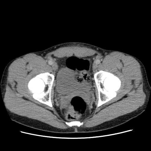 Appendicitis complicated by post-operative collection (Radiopaedia 35595-37114 A 80).jpg