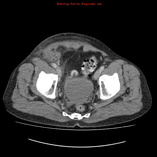 File:Appendicitis mass in inguinal hernia (Radiopaedia 26858-27029 A 22).jpg