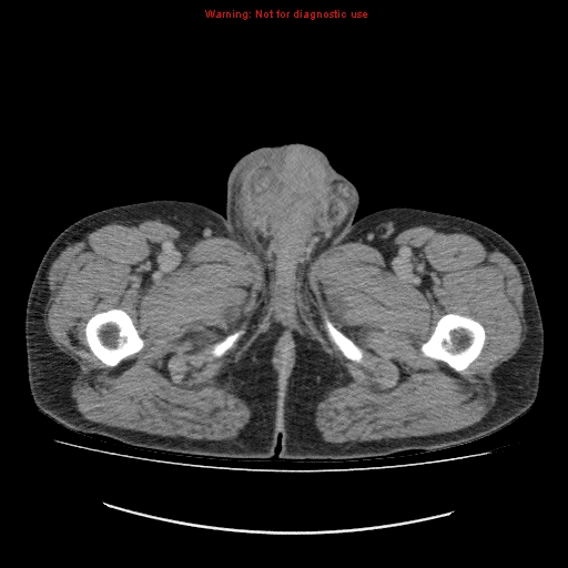File:Appendicitis mass in inguinal hernia (Radiopaedia 26858-27029 A 42).jpg