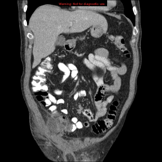 File:Appendicitis mass in inguinal hernia (Radiopaedia 26858-27029 B 20).jpg
