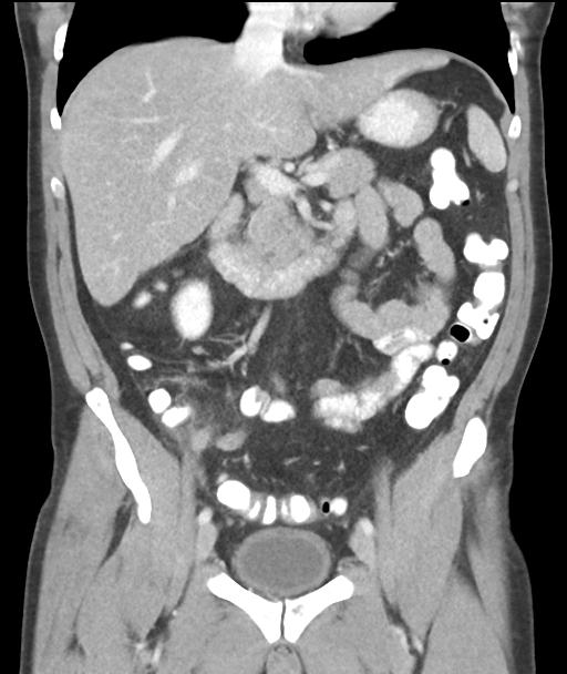 Appendicitis with cecal bar sign (Radiopaedia 31878-32830 A 30).jpg