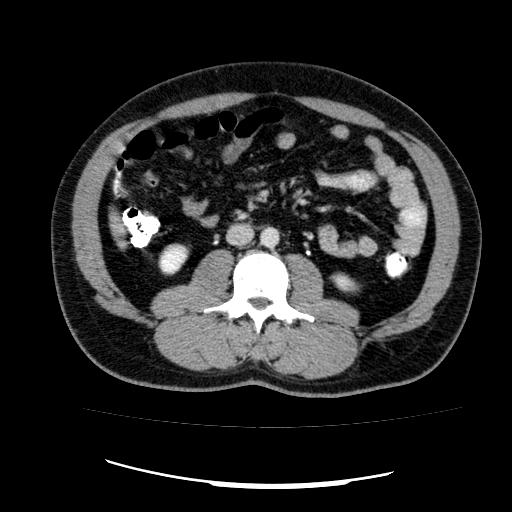 File:Appendicitis with diverticulosis (Radiopaedia 47693-52383 Axial C+ 70).jpg