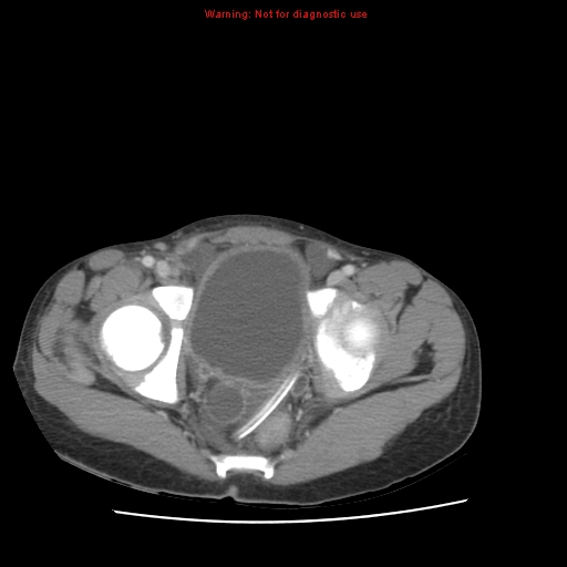 Appendicitis with phlegmon (Radiopaedia 9358-10046 A 65).jpg