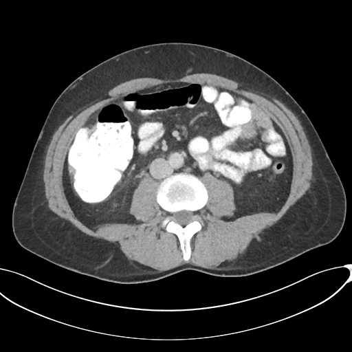 Appendicitis with thickening of the terminal ileum (Radiopaedia 42432-45550 A 54).png