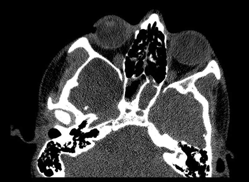 File:Arachnoid cyst- extremely large (Radiopaedia 68741-78450 Axial bone window 14).jpg