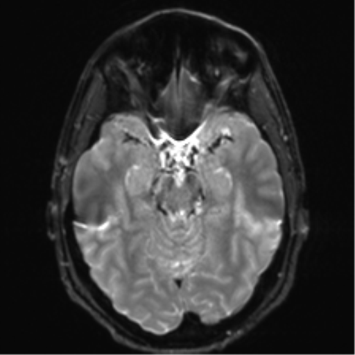 Arachnoid cyst - cerebellopontine angle (Radiopaedia 59689-67083 Axial DWI 14).png