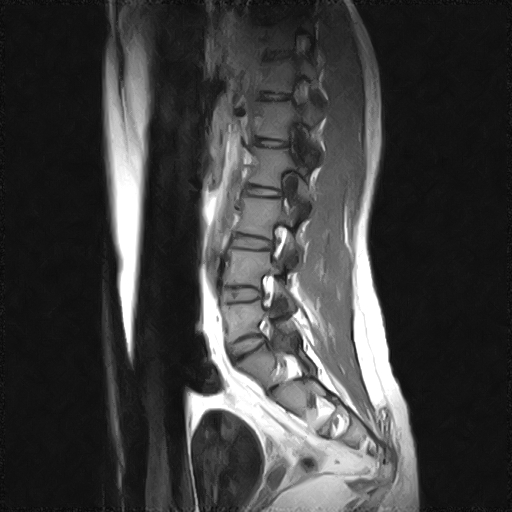 File:Arachnoid cyst - spinal (Radiopaedia 66835-76157 Sagittal T1 3).jpg