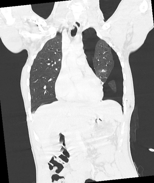 Arrow injury to the chest (Radiopaedia 85367-100975 Coronal lung window 65).jpg