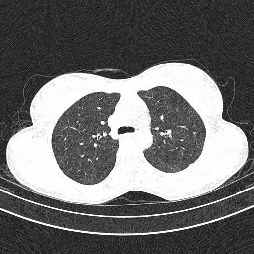 File:Arteria lusoria (Radiopaedia 88528-105192 Axial lung window 23).jpg