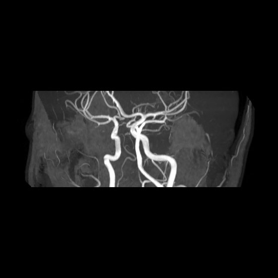File:Artery of Percheron infarct (Radiopaedia 40966-43676 G 40).jpg