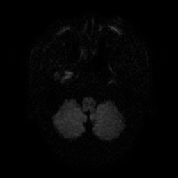 File:Artery of Percheron infarction (Radiopaedia 27975-28230 Axial DWI 6).jpg