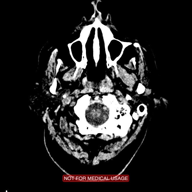 Artery of Percheron infarction (Radiopaedia 28679-28967 Axial non-contrast 6).jpg
