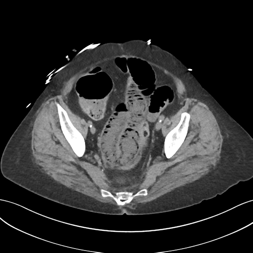 File:Ascending cholangitis (Radiopaedia 39068-41253 Axial non-contrast 56).png