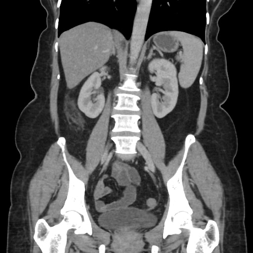Ascending colon diverticulitis (Radiopaedia 61970-70040 B 38).jpg
