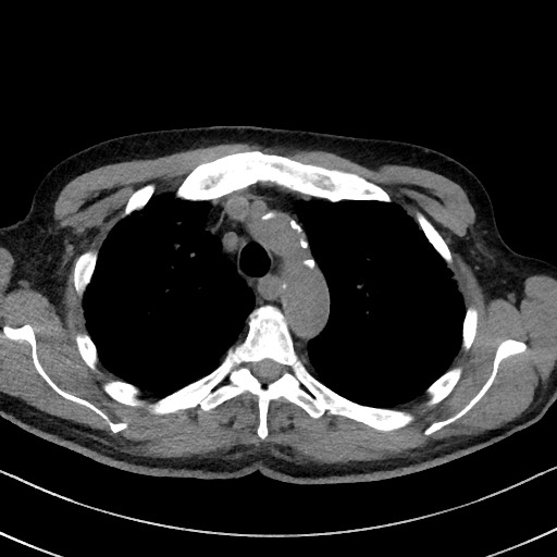 Aspergilloma on background pulmonary fibrosis (Radiopaedia 60942-68757 Axial non-contrast 18).jpg