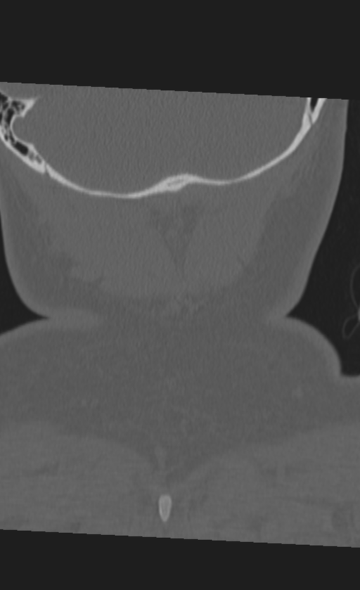 Atlanto-occipital dissociation (Radiopaedia 33848-35013 Coronal bone window 56).png