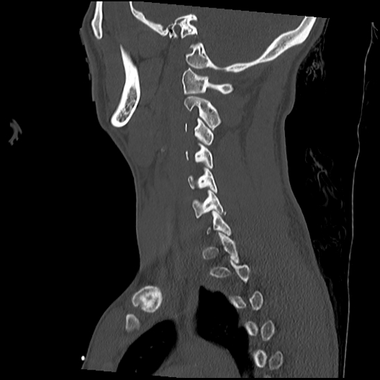 Atlanto-occipital dissociation (Traynelis type 1), C2 teardrop fracture, C6-7 facet joint dislocation (Radiopaedia 87655-104061 Sagittal bone window 46).jpg