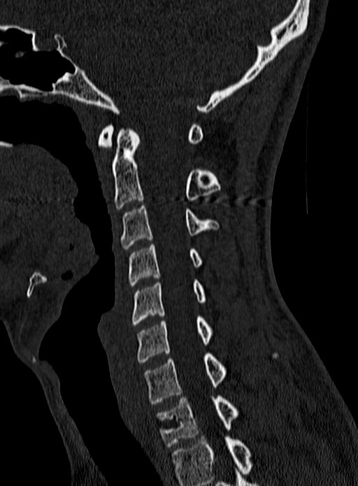 Atlantoaxial subluxation (Radiopaedia 44681-48450 Sagittal bone window 63).jpg