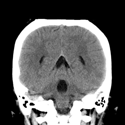 File:Atretic encephalocoele with inferior vermis hypoplasia (Radiopaedia 30443-31107 Coronal non-contrast 27).jpg