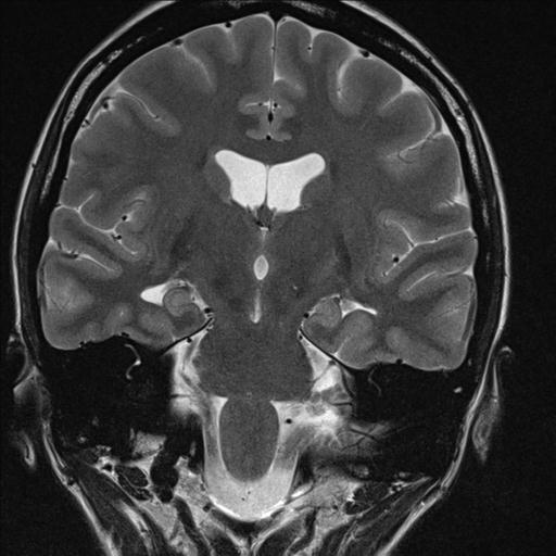 File:Atretic encephalocoele with inferior vermis hypoplasia (Radiopaedia 30443-31108 Coronal T2 6).jpg