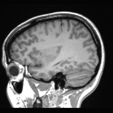 Atretic encephalocoele with inferior vermis hypoplasia (Radiopaedia 30443-31108 Sagittal T1 33).jpg
