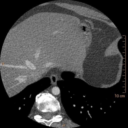 Atrial septal defect (upper sinus venosus type) with partial anomalous pulmonary venous return into superior vena cava (Radiopaedia 73228-83961 A 267).jpg