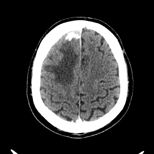Atypical meningioma (WHO grade II) with brain invasion (Radiopaedia 57767-64728 Axial C+ 14).png