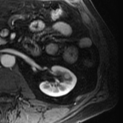 File:Atypical renal cyst on MRI (Radiopaedia 17349-17046 C 17).jpg